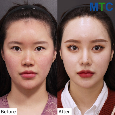 Forehead Lift Reduction