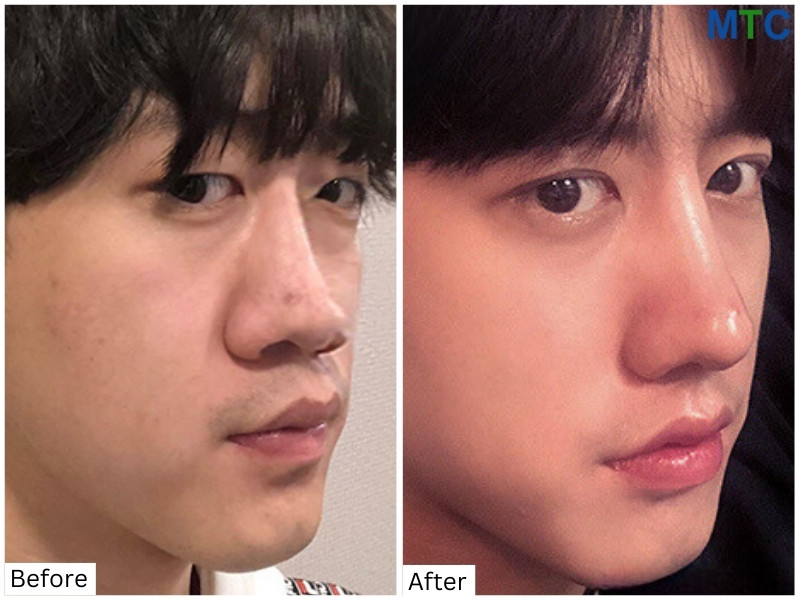 Rhinoplasty: Before & after image