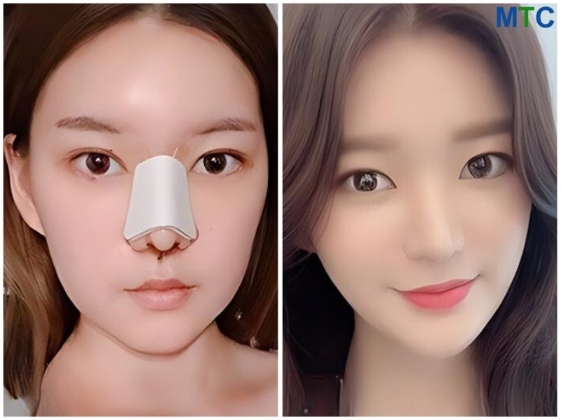 Customer Recovery from Rhinoplasty in Seoul Korea