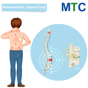 Herniated-Disc