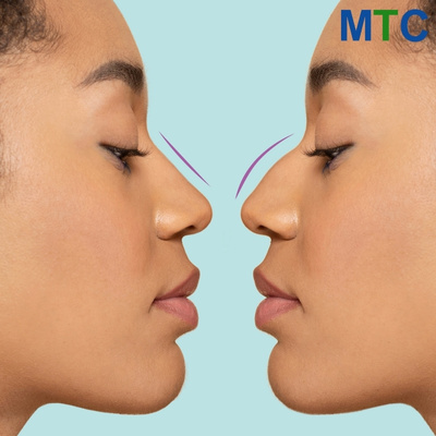 Nose Bridge Rhinoplasty 