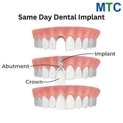 Same Day Dental Implant