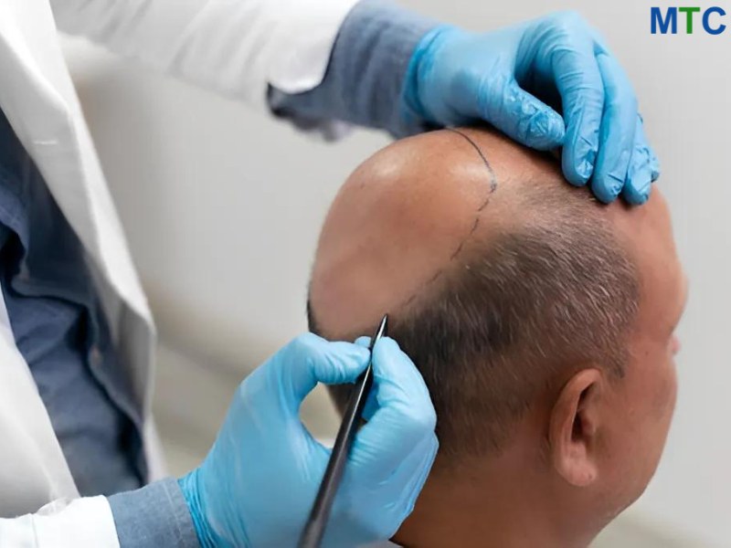 Doctor marking the scalp area