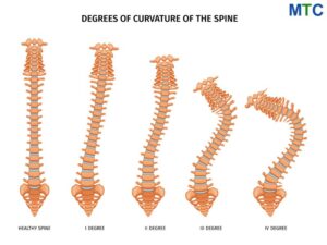 Scoliosis surgery