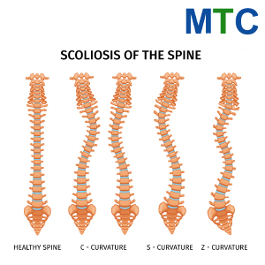 Scoliosis