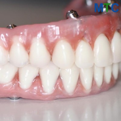 Snap-On Dentures