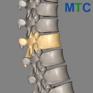 Spinal Fractures