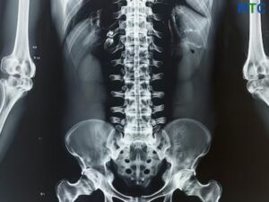 Spinal Fusion