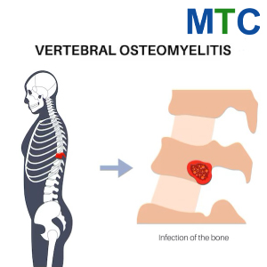 Spine Infections