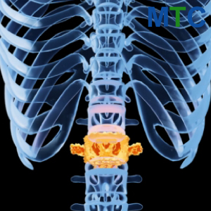 Spine Tumors