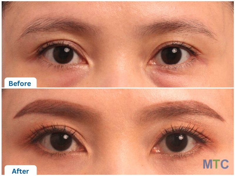 Korean Blepharoplasty Before and After Results