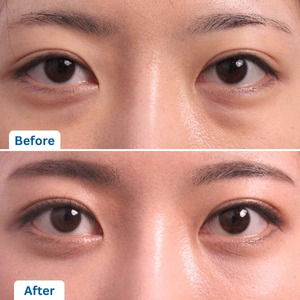 Under Eye Fat Reposition Surgery