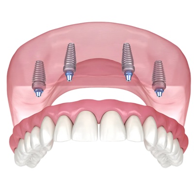 All on 4 Dental Implants