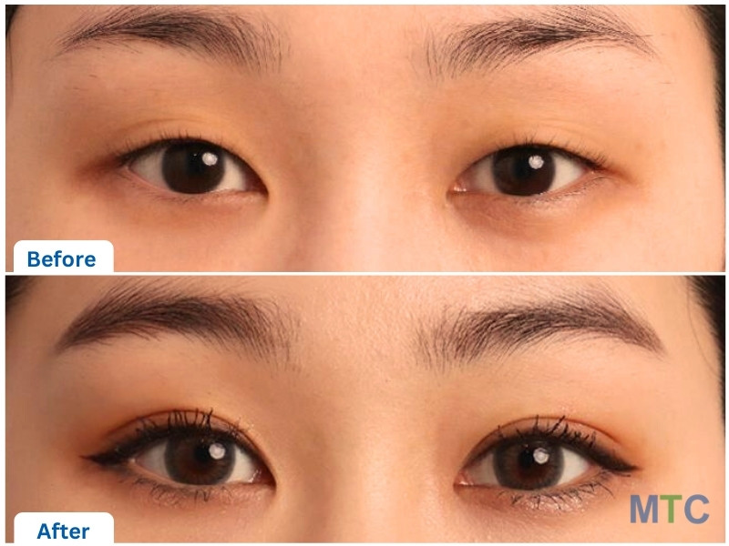 Korean Blepharoplasty Before and After Results