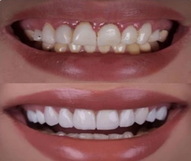 20 Crowns - Hollywood Smile Makeover at BFC Dental Bangna