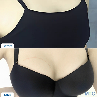 Before and after picture of a patient for Breast Augmentation in Seoul | VG Plastic Surgery