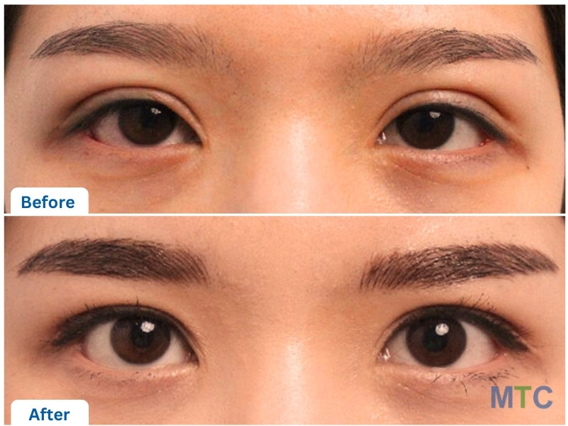 Korean Blepharoplasty Before and After Results