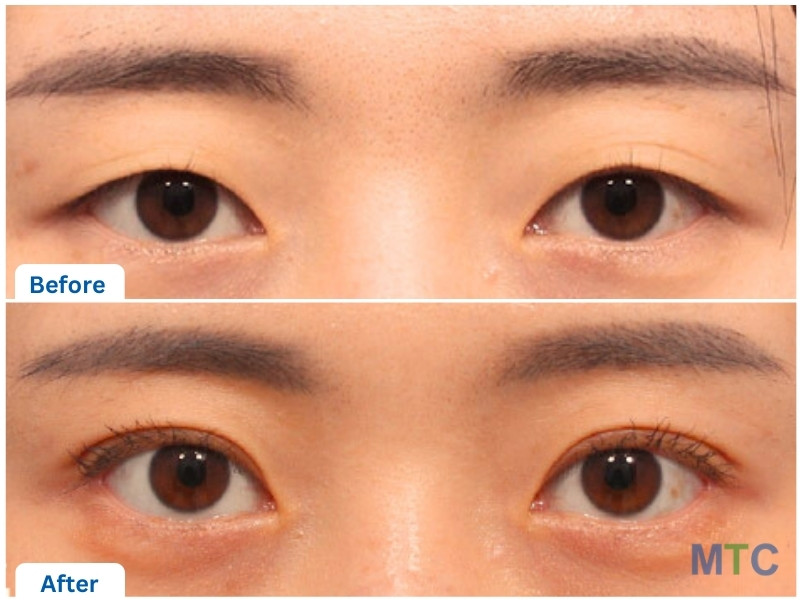 Korean Blepharoplasty Before and After Results