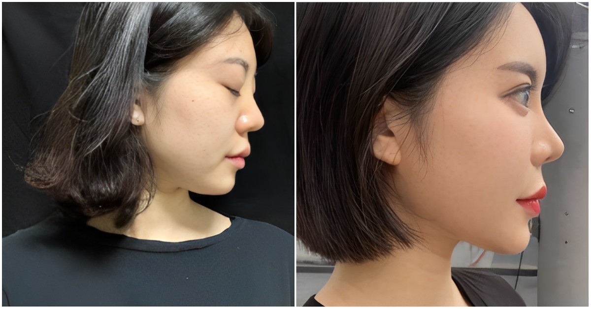 Rhinoplasty in Seoul, Korea