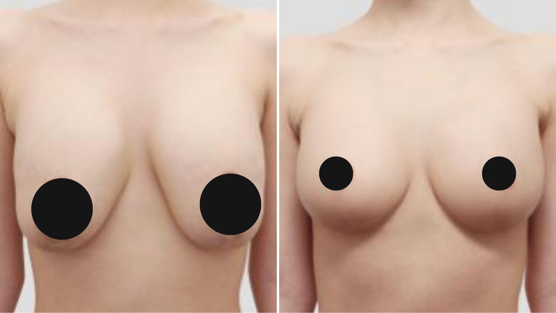 Before and after of a patient at Note Plastic Surgery for breast reduction 