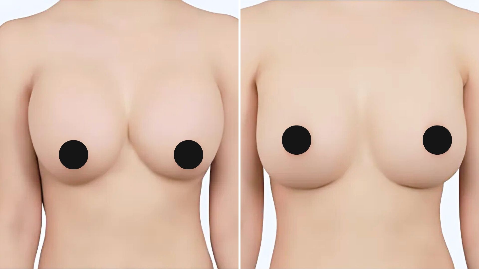 Before and after picture for breast revision surgery of a patient at Note Plastic Surgery