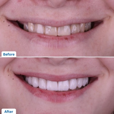 Dental Veneers