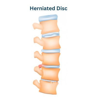 Disc Degeneration