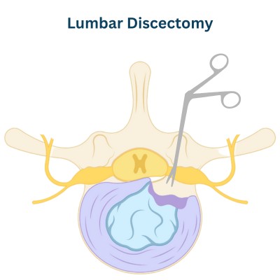 Lumbar Discectomy