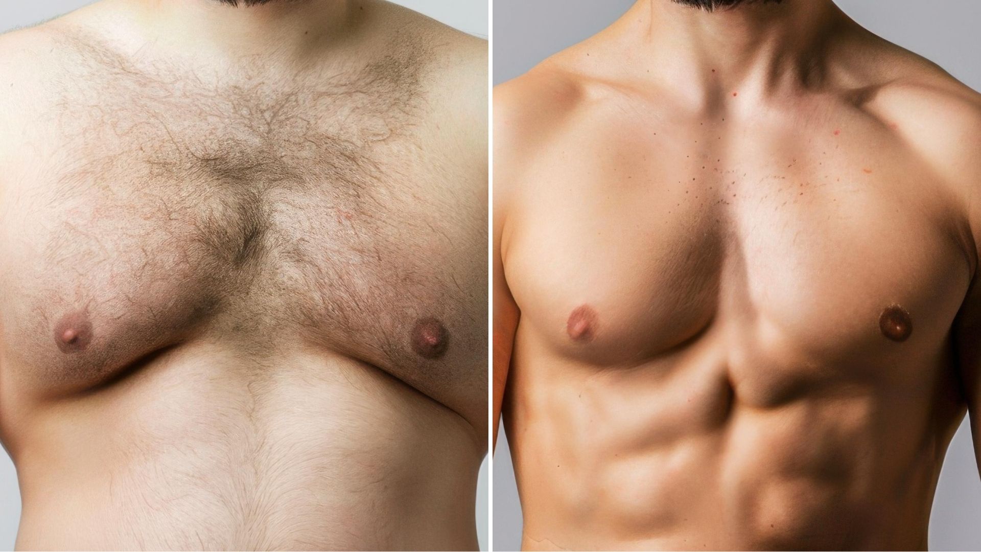 Before and after picture of a man after gynecomastia correction surgery