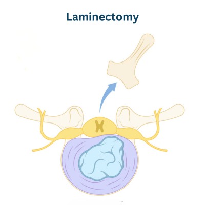 Laminectomy