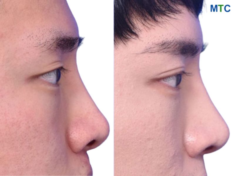 Male rhinoplasty before and after