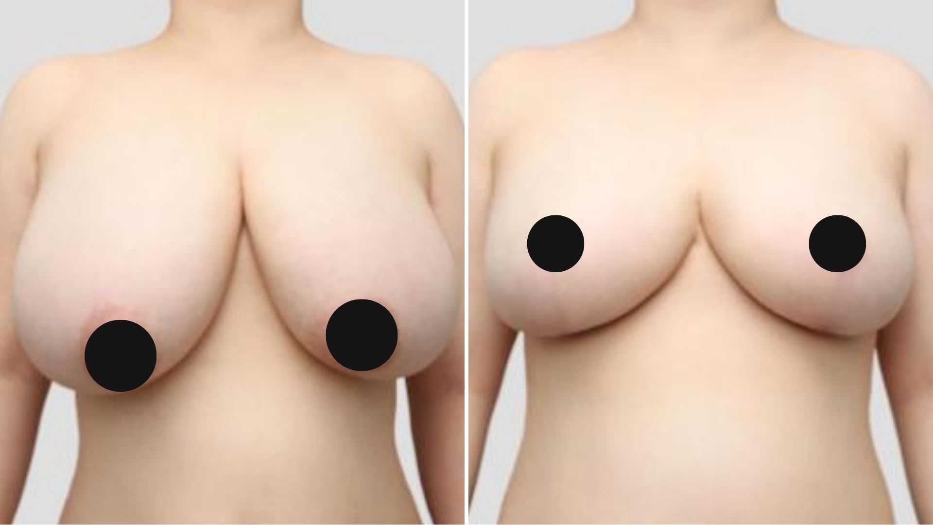 Before and after image of a patient at Note Plastic Surgery 