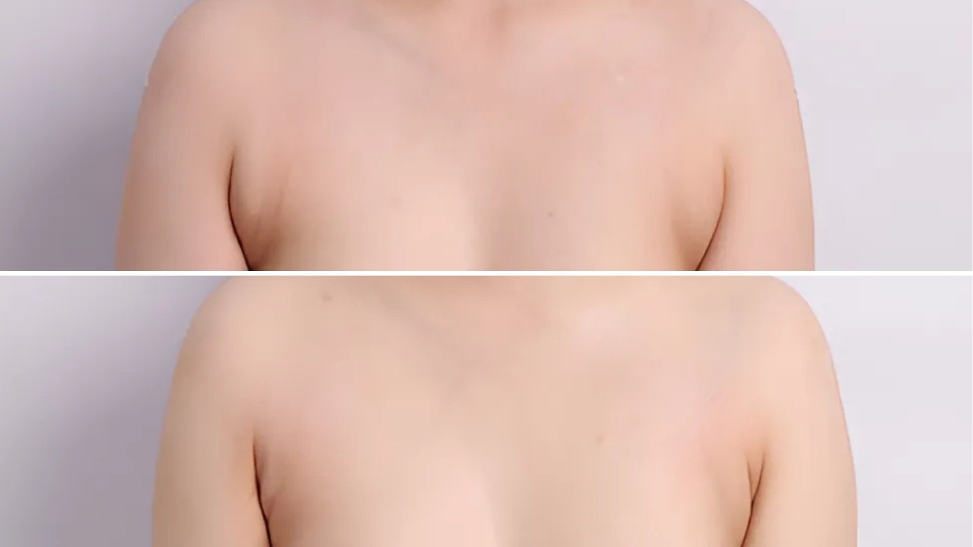 Before and after of a Polymastia patient at Ruby Plastic Surgery 