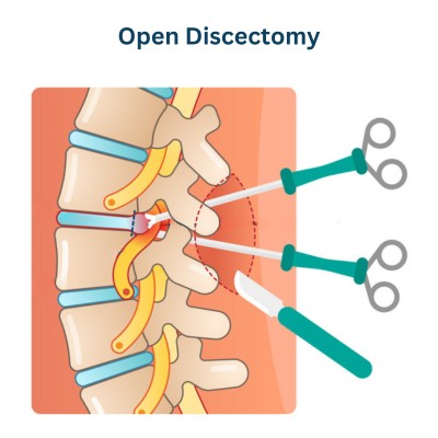 Open Discectomy - Revision Spine Surgery