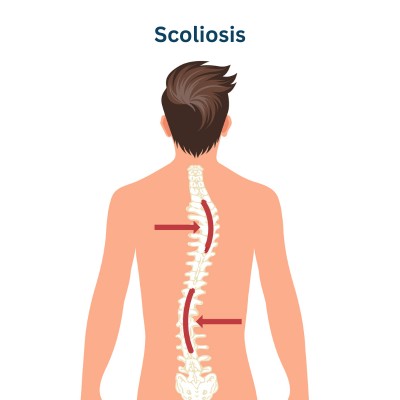 Scoliosis Disease