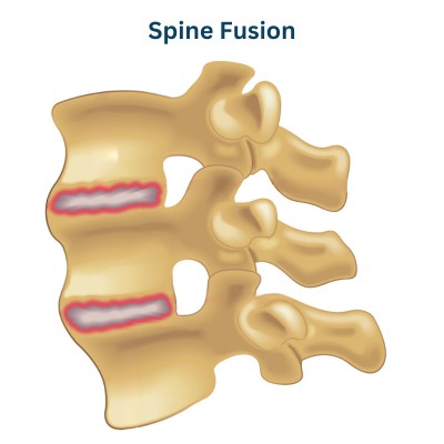 Spine Fusion Surgery