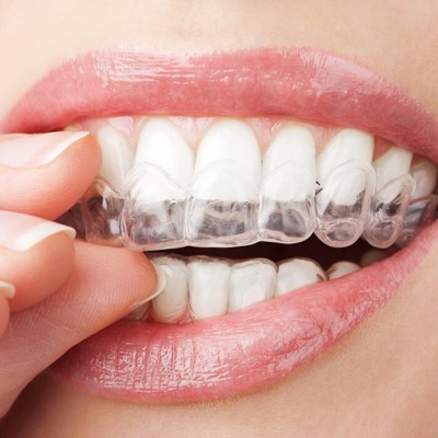 Invisalign