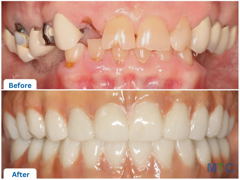 Two pictures of teeth one below the other showing before and after of all-on-4 Straumann implants in mexico