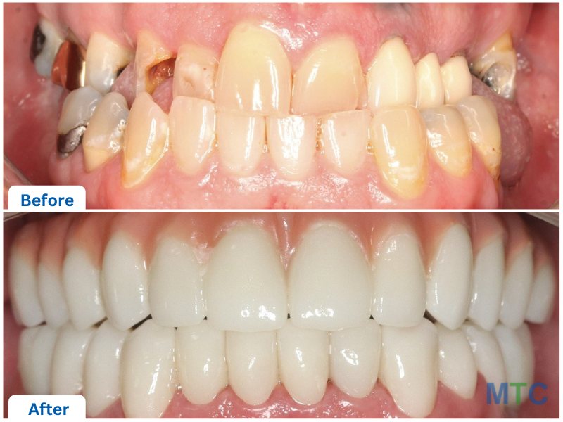 Two pictures of teeth one below the other showing before and after of dental implants with zirconia crowns in mexico