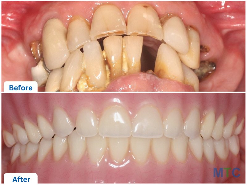 Two pictures of teeth one below the other showing before and after of dentures in mexico