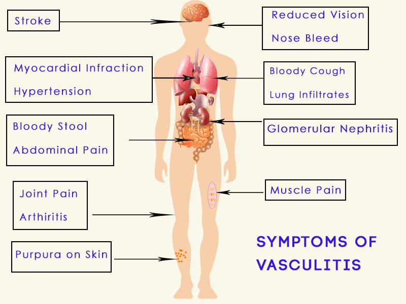 Symptoms of Vasculitis