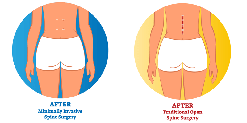 differnce between invasive and minimally inasive spine surgery