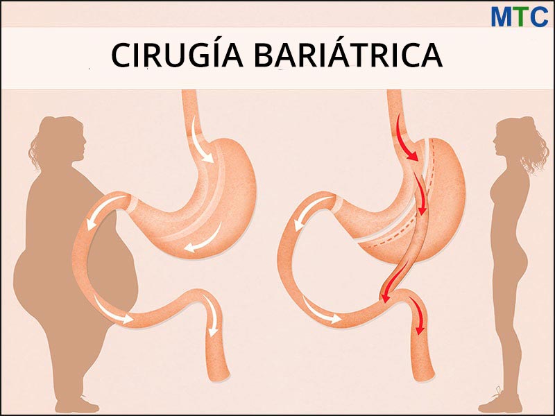 Cirugía Bariátrica