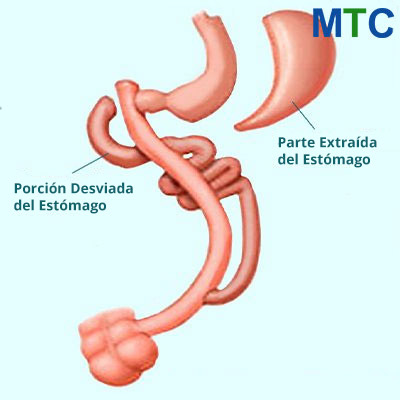 Cruce Duodenal