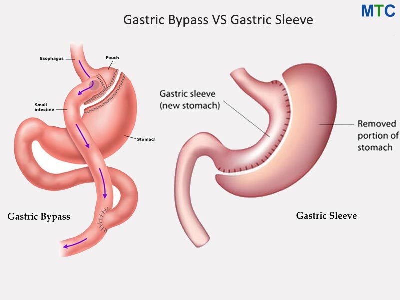 Bypass gástrico vs manga gástrica 