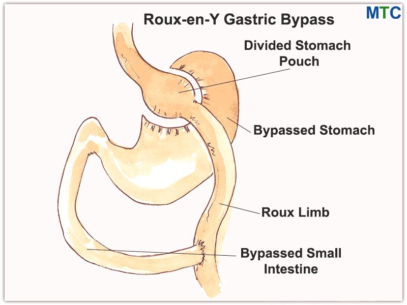 Gastric Bypass