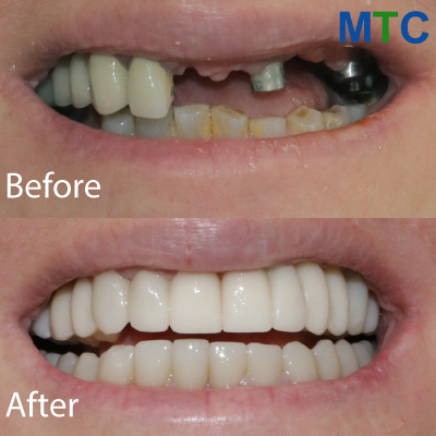 Zadar Dental Work Before & After