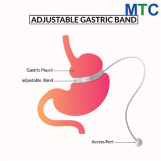 Gastric Band in Turkey