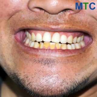 Veneers Conceal Discoloration