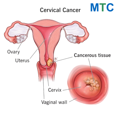 Cervical Cancer Treatment